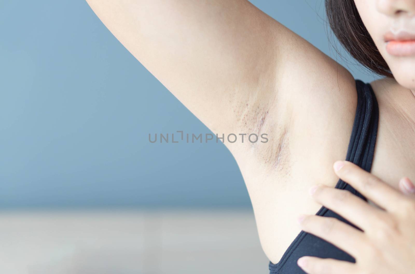 Women problem black armpit lying on white bed background for skin care and beauty concept, selective focus