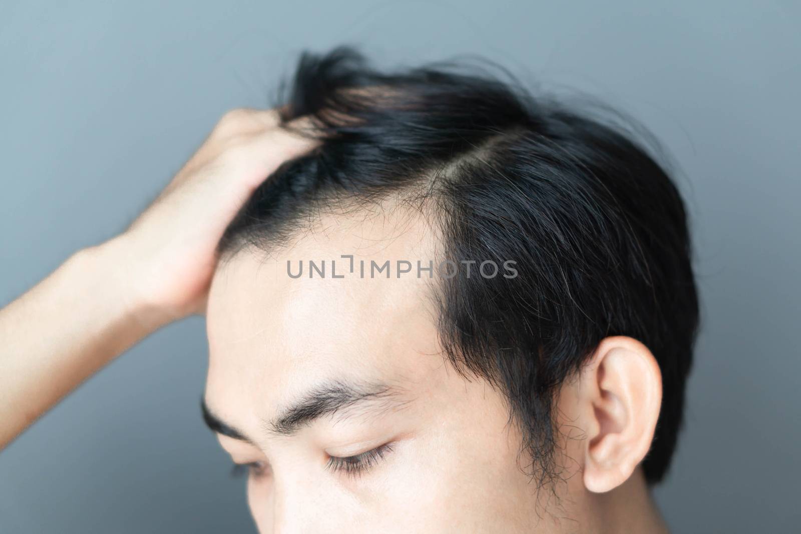 Young man serious hair loss problem for health care medical and shampoo product concept