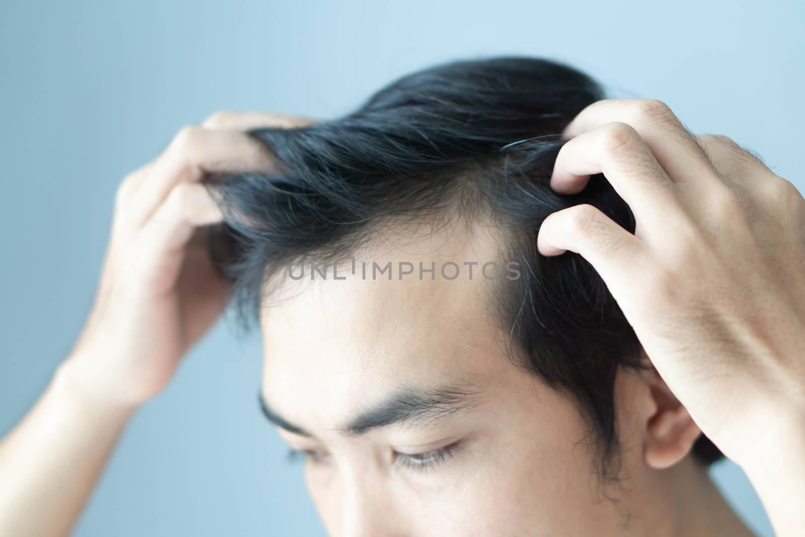 Young man serious hair loss problem for health care medical and shampoo product concept, selective focus