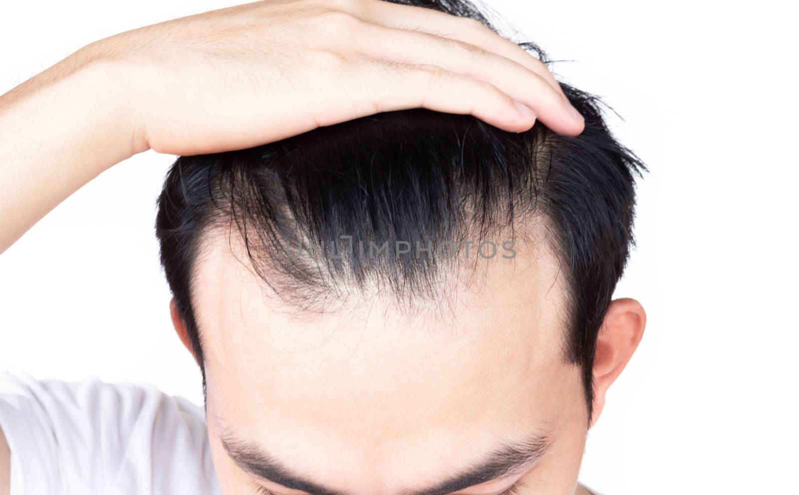 Young man serious hair loss problem for health care medical and shampoo product concept