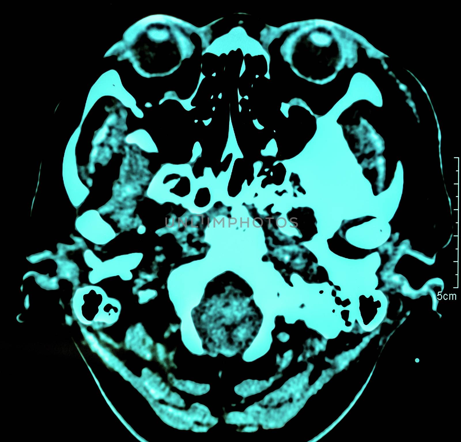 Computerized film x-ray tomography of human brain, CT Scan, Medical concept