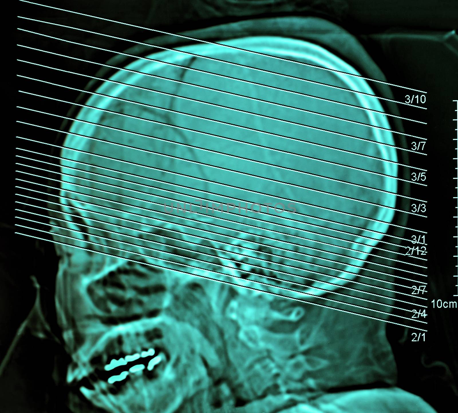Computerized film x-ray tomography of human brain, CT Scan, Medical concept