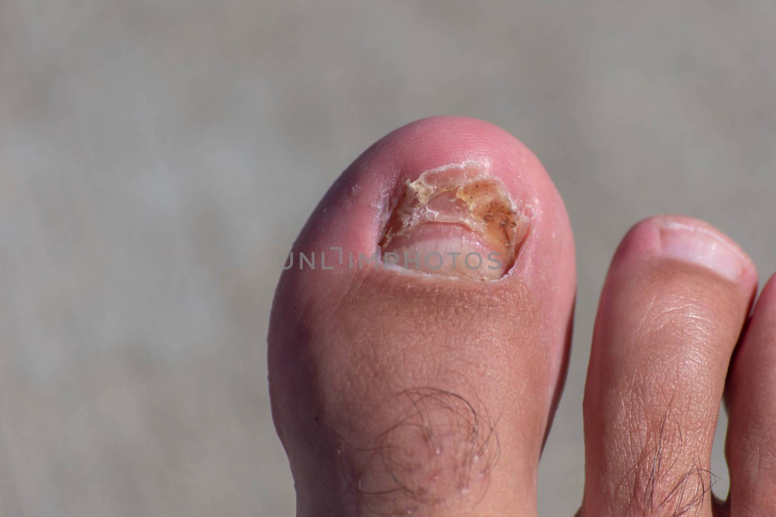 Big toe nail broken off and growing back after an injury. by kingmaphotos