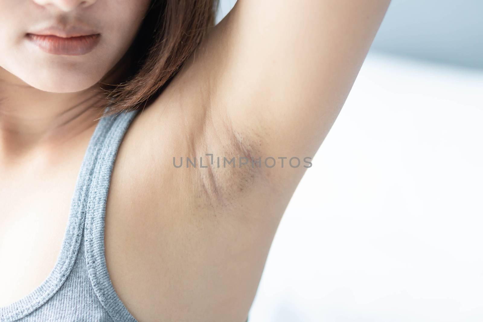 Women problem black armpit lying on white bed background for ski by pt.pongsak@gmail.com