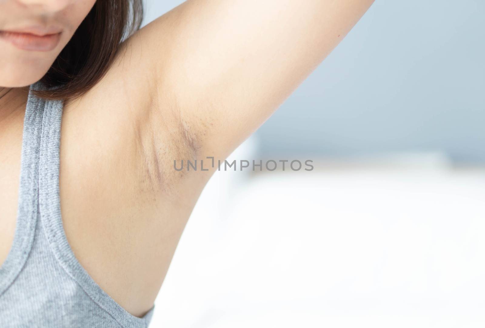 Women problem black armpit lying on white bed background for skin care and beauty concept, selective focus