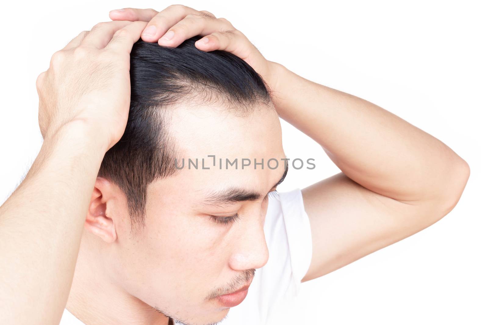 Young man serious hair loss problem for health care medical and shampoo product concept