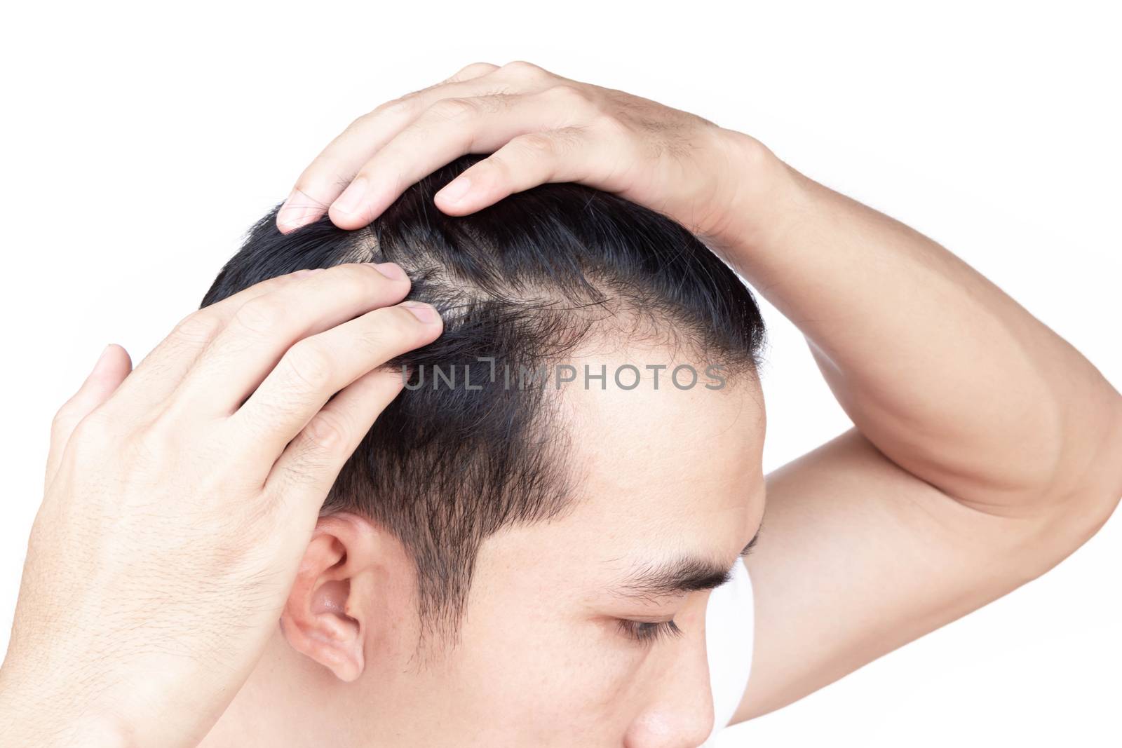 Young man serious hair loss problem for health care medical and shampoo product concept