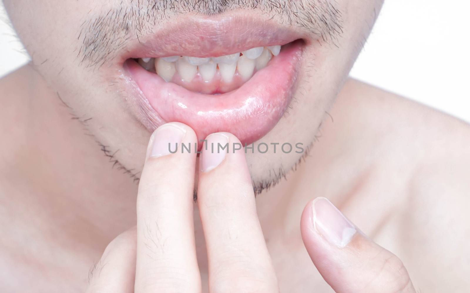 Closeup of lips man problem health care, Herpes simplex