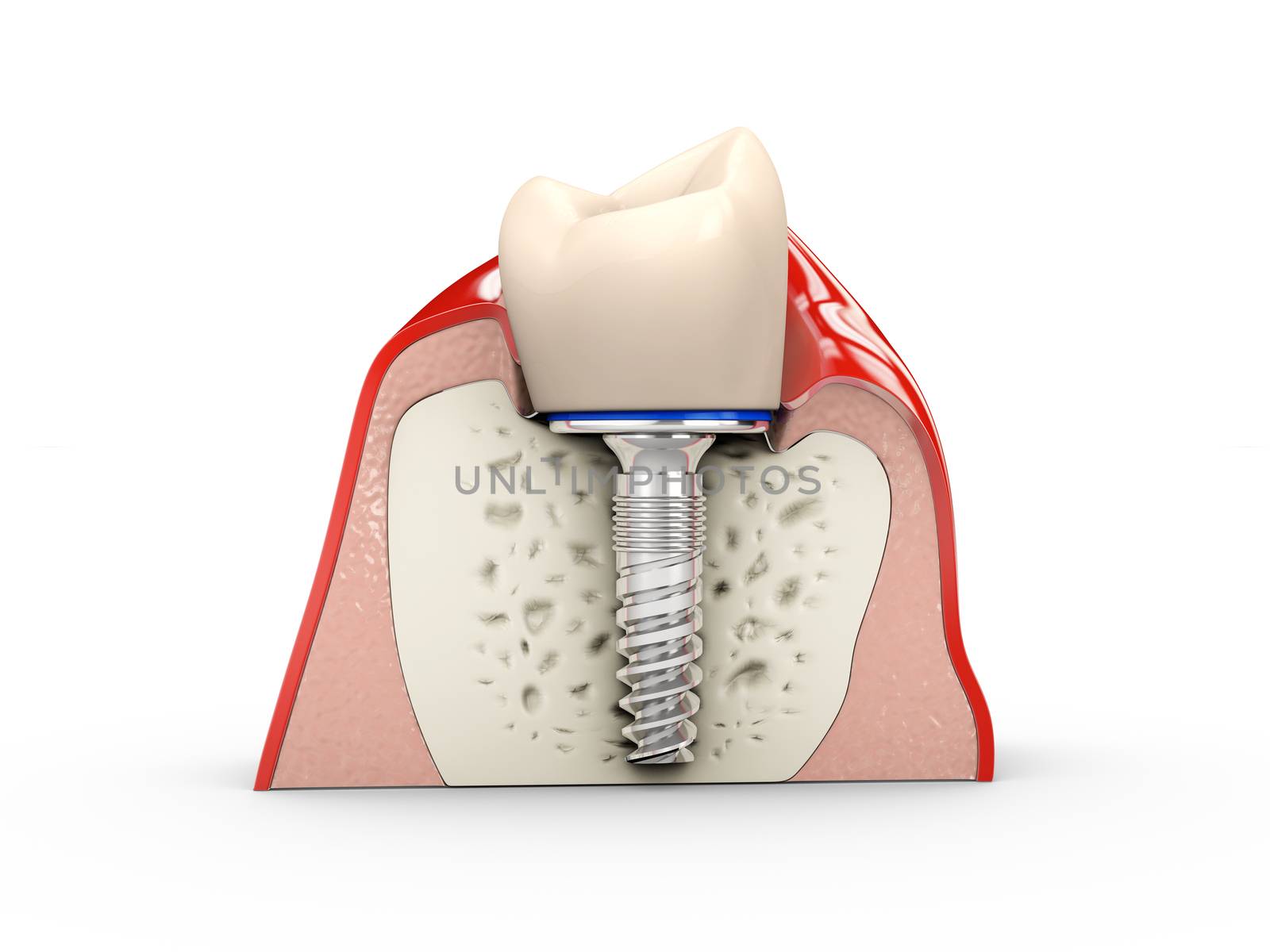 Human teeth and Dental implant 3d Illustration by tussik