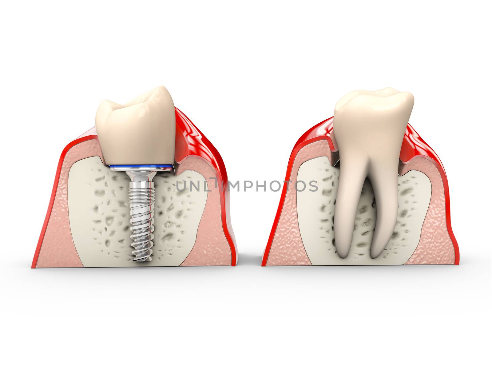 Human teeth and Dental implant 3d Illustration.