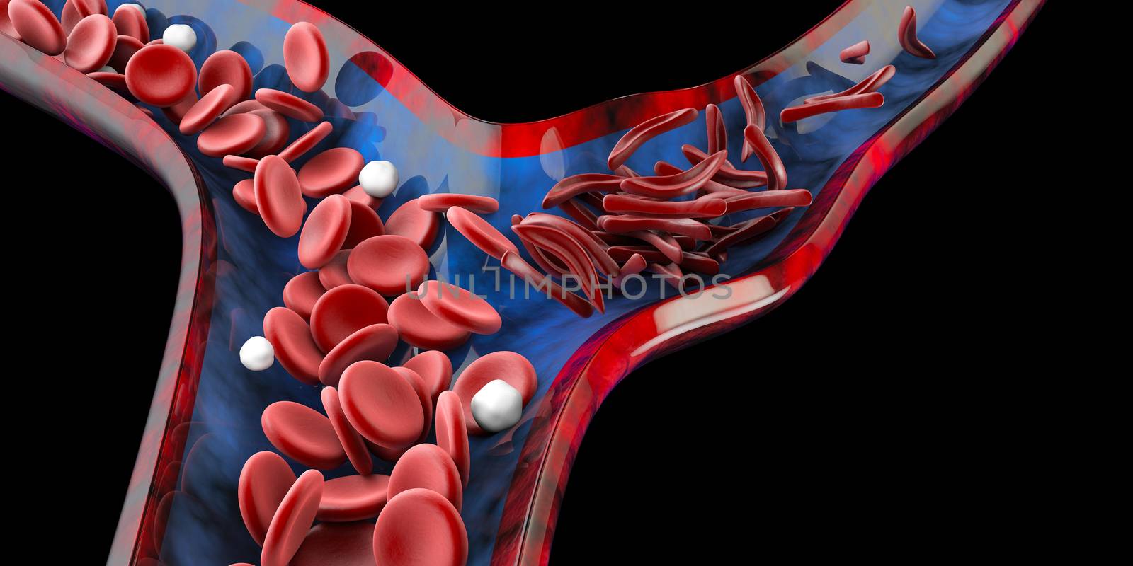 Sickle cell anemia, showing blood vessel with normal and deformated crescent. 3D illustration.