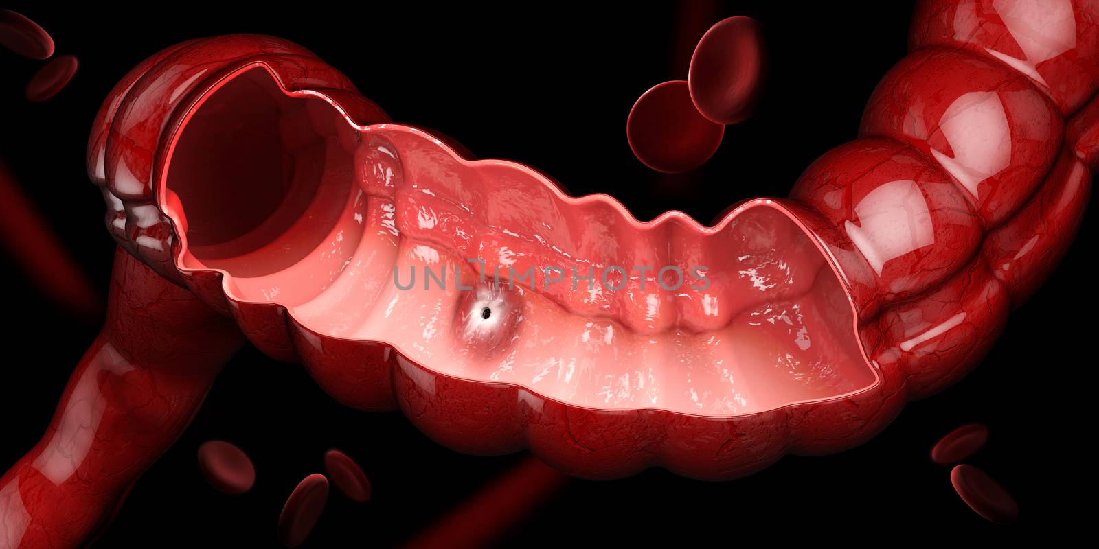Peptic ulcer, 3d illustration of human stomach anatomy