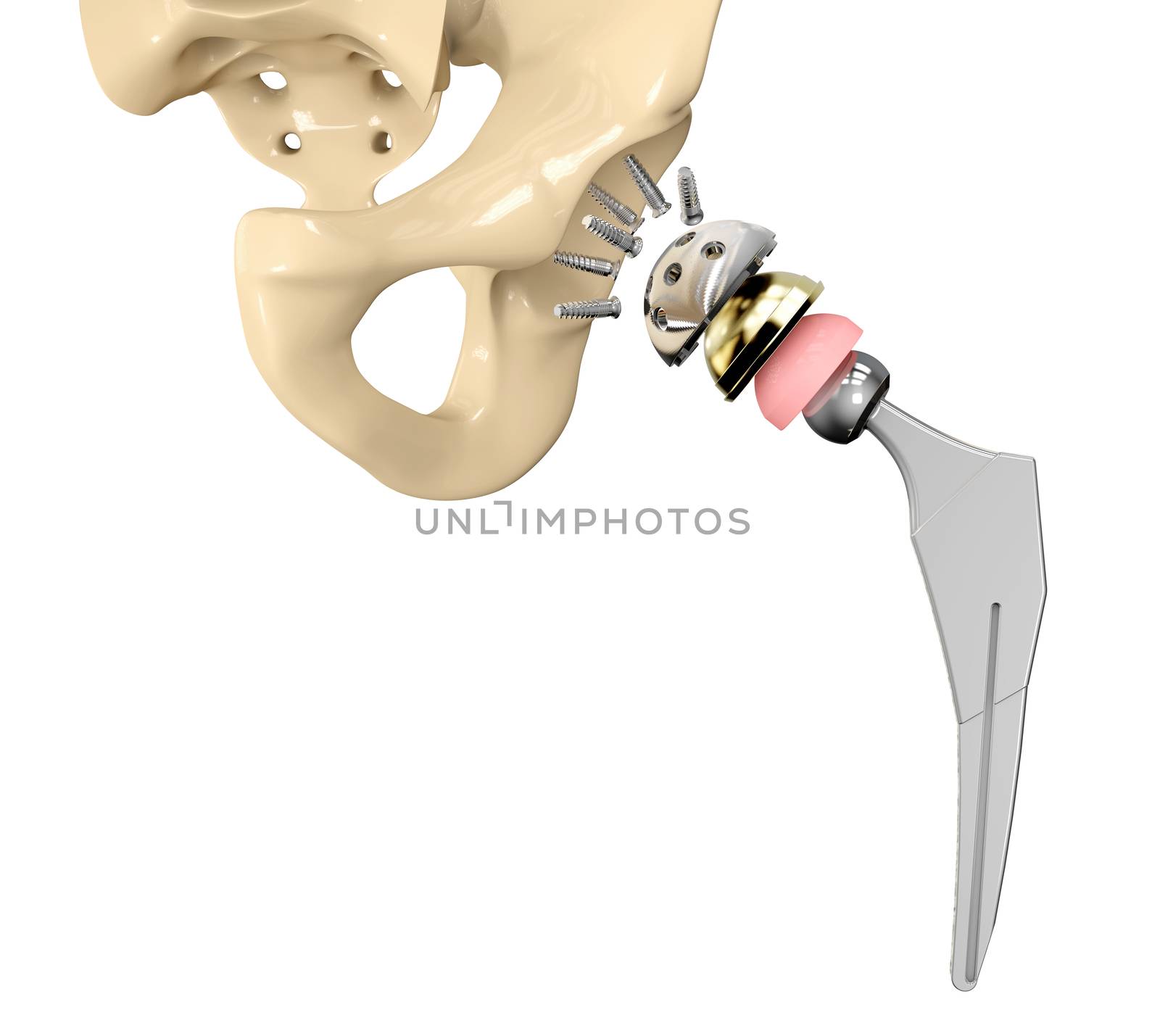 3D illustration of Hip replacement implant installed in the pelvis bone.
