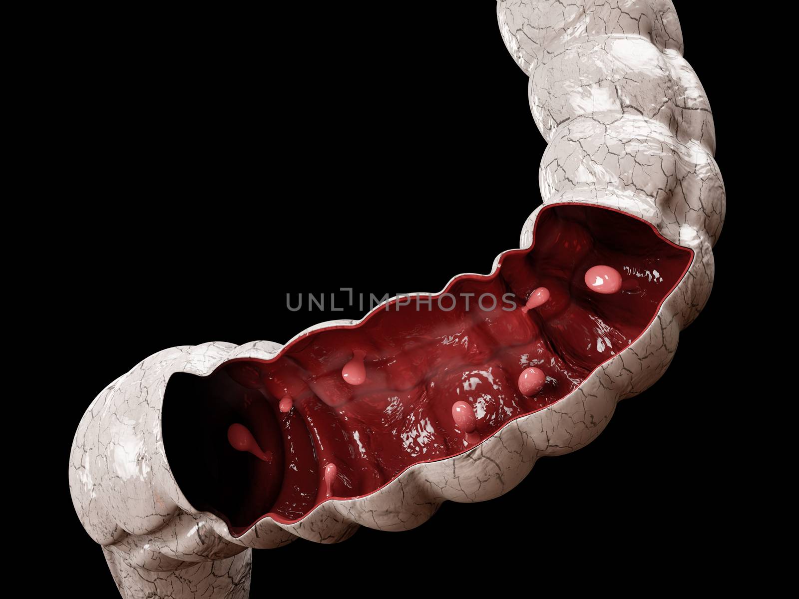 Colon polyps. 3d illustration, Polyp in the intestine