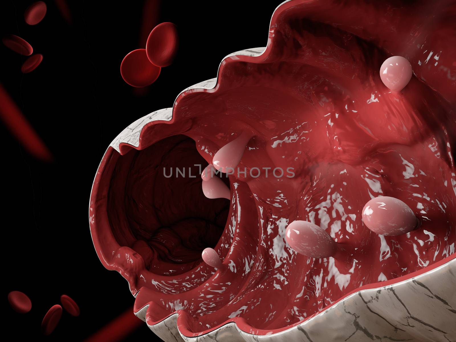 Colon polyps. 3d illustration, Polyp in the intestine. by tussik