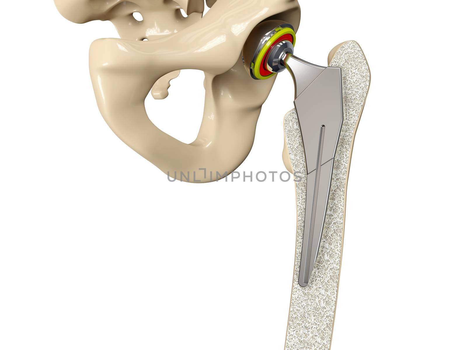3D illustration of Hip replacement implant installed in the pelvis bone by tussik