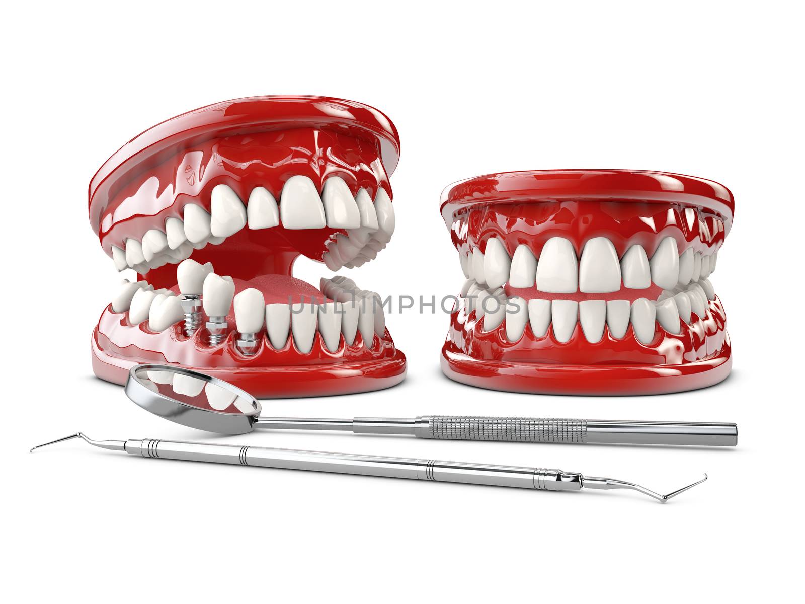 Tooth human implant. Dental concept 3d illustration.
