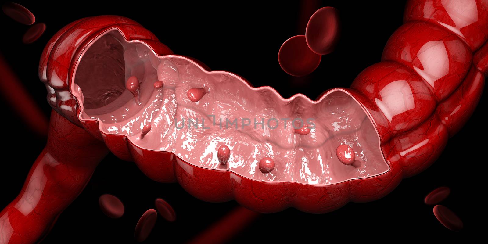 3d illustration of Colon polyps. Polyp in the intestine. isolated black