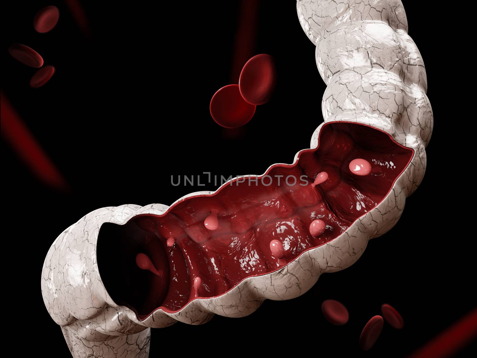 Colon polyps. 3d illustration, Polyp in the intestine