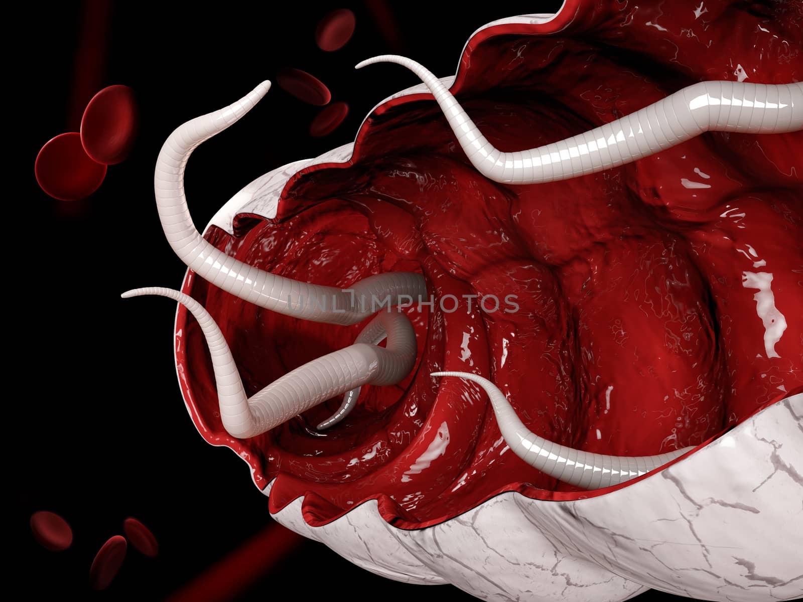 3d Illustration of a hookworm in the large intestine.