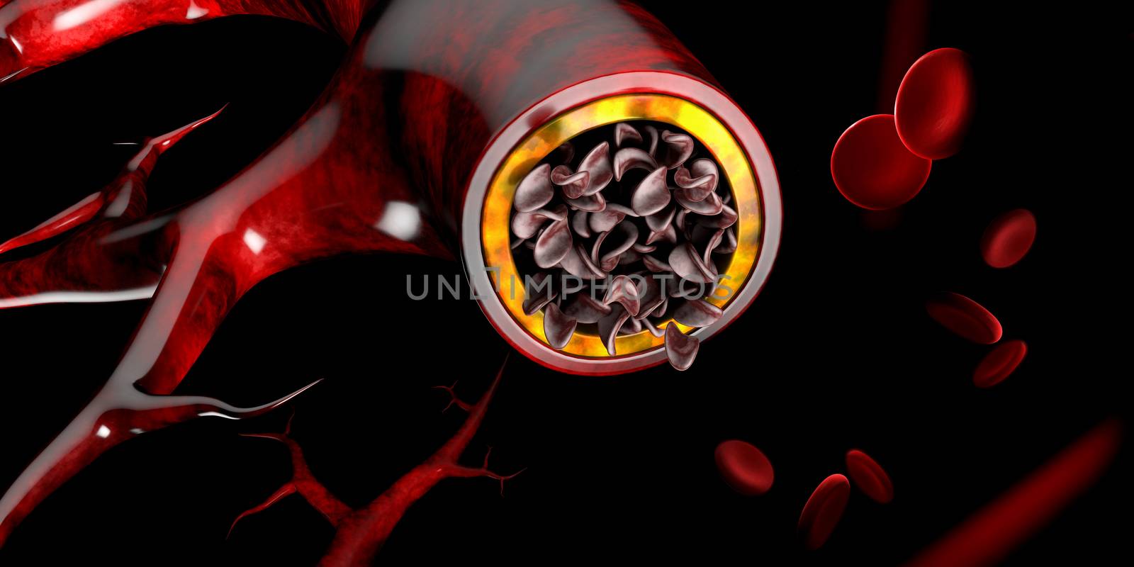 Sickle cell anemia, showing blood vessel with normal and deformated crescent. 3D illustration.