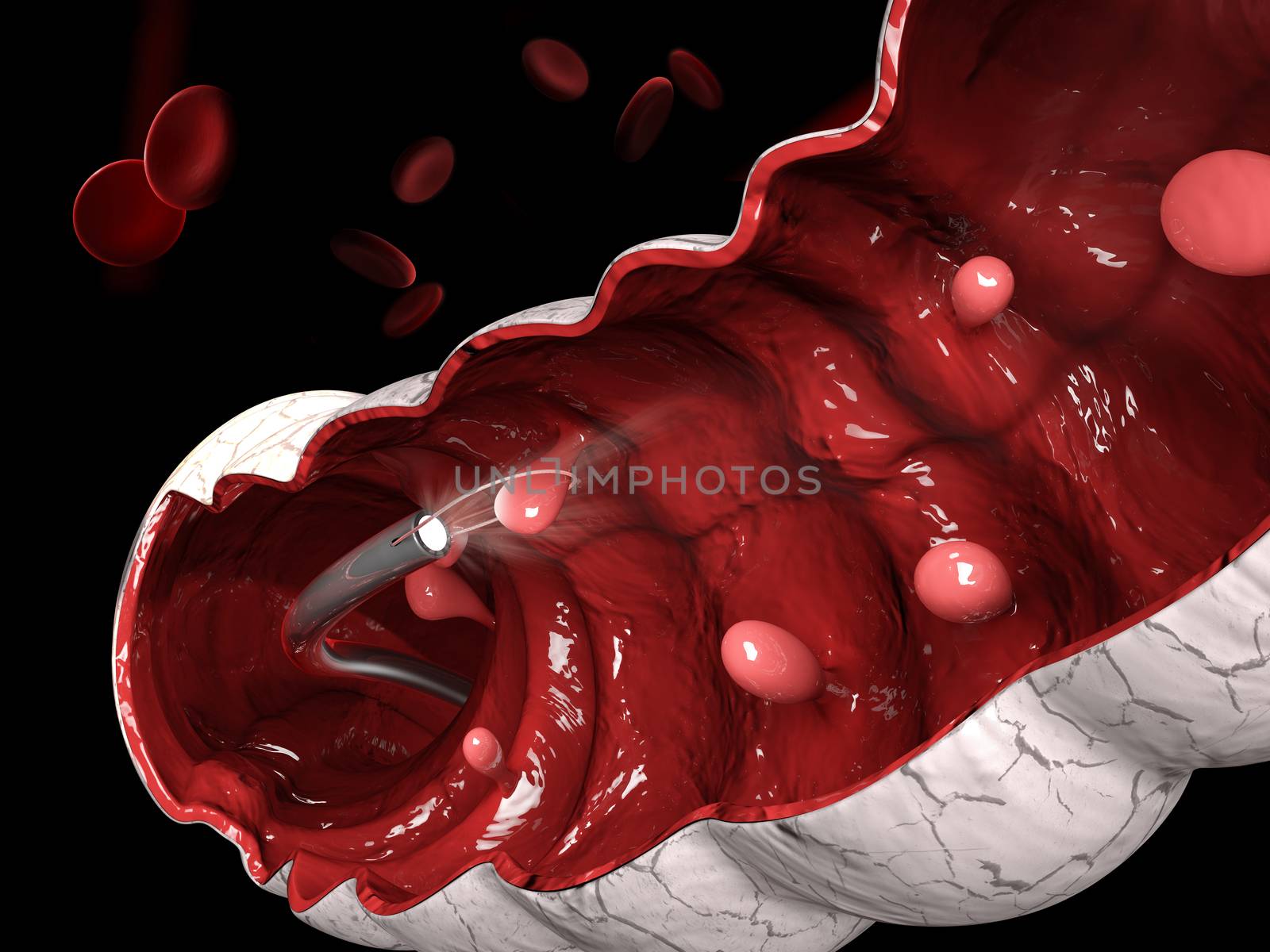 3d illustration of Removal of a colonic polyp with a electrical wire loop during a colonoscopy. by tussik