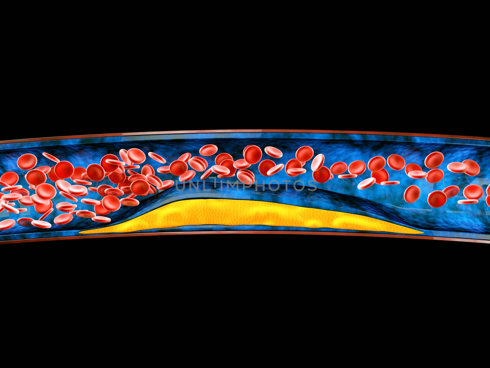 3d Illustration of blood cells with plaque buildup of cholesterol.