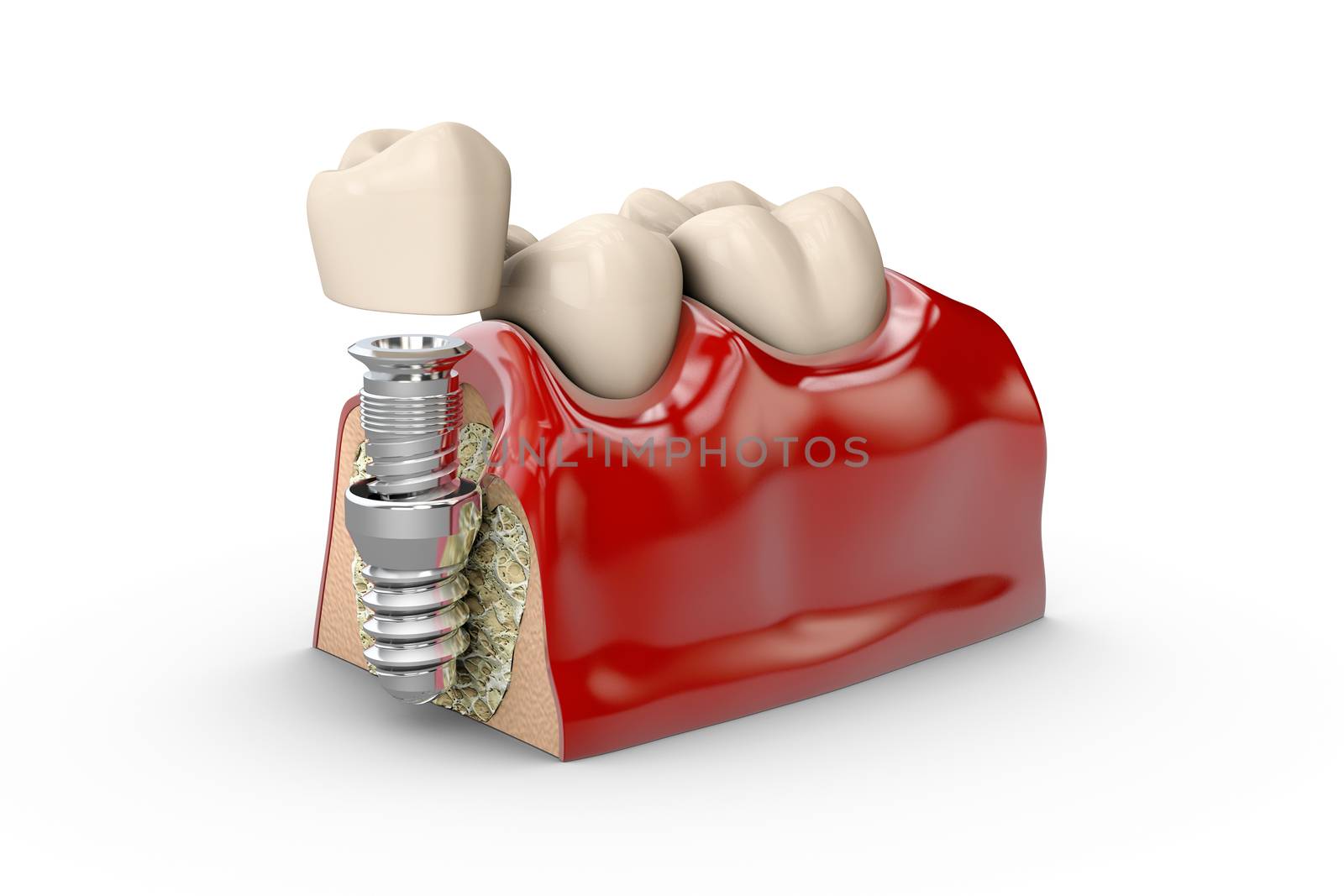 3d illustration of tooth dental implant model by tussik