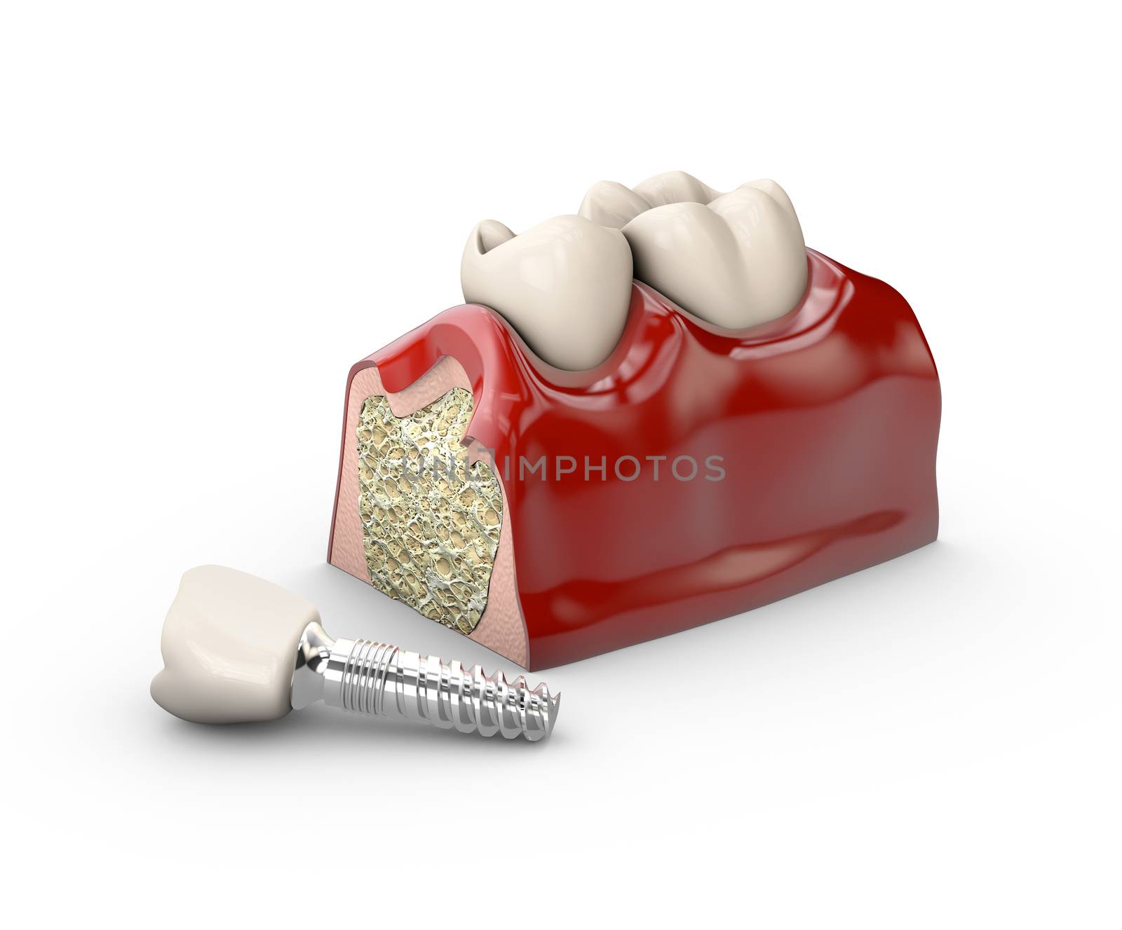 tooth dental implant model 3d illustration.