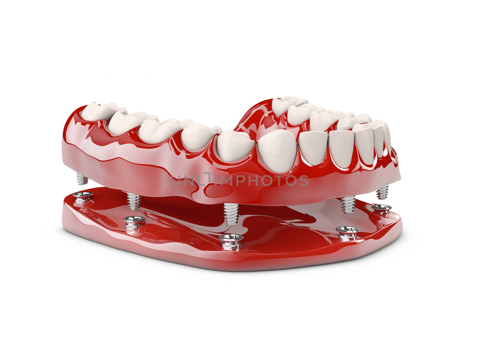 Human teeth and Dental implant. 3d illustration by tussik