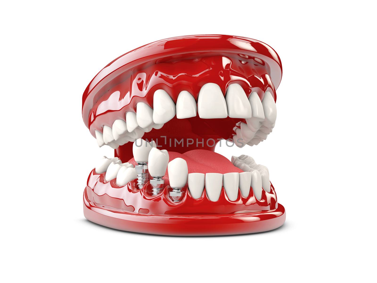 Tooth human implant. Dental concept 3d illustration by tussik