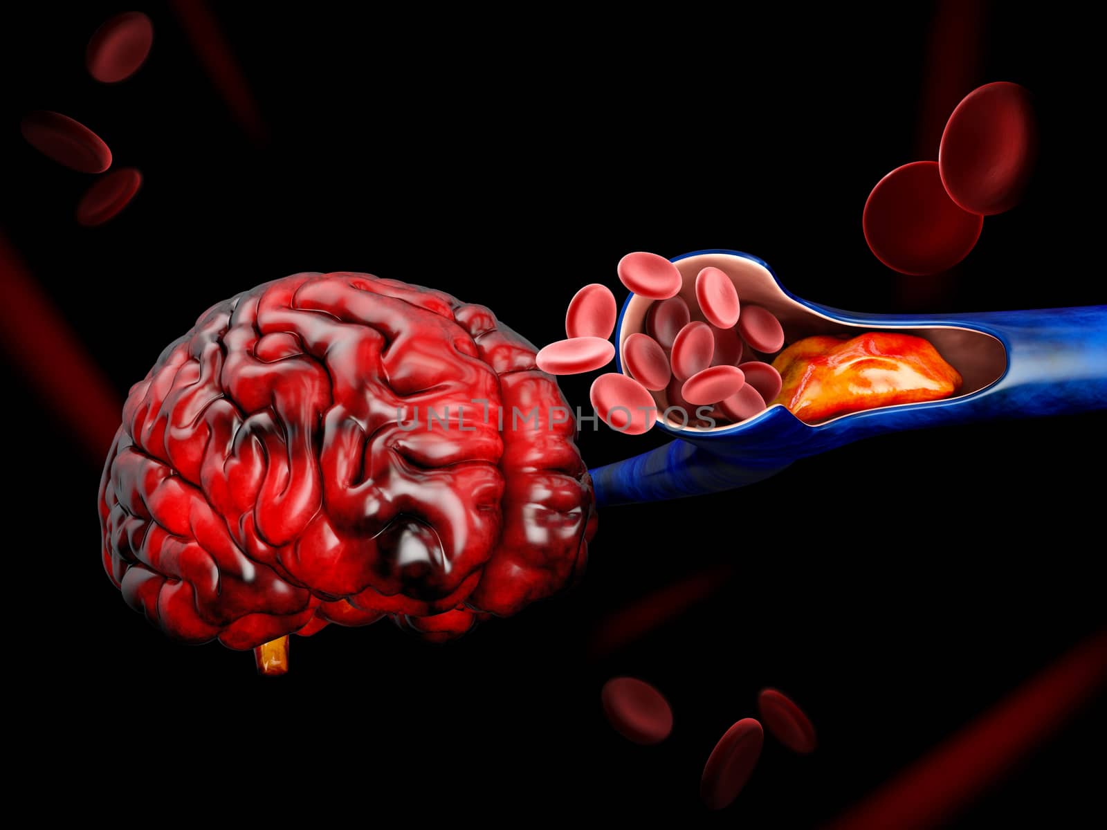 3d Illustration of Deep Vein Thrombosis or Blood Clots. Embolism by tussik