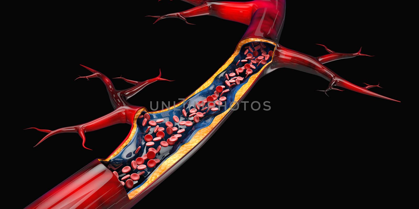 3d Illustration of blood cells with plaque buildup of cholesterol isolated black.