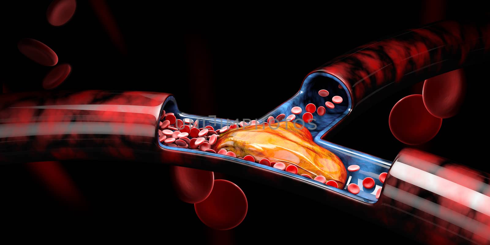 3d Illustration of Deep Vein Thrombosis or Blood Clots, Embolism. by tussik