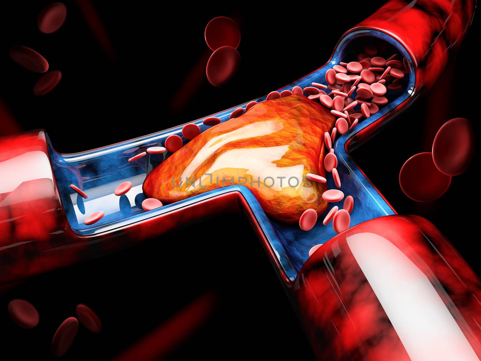 3d Illustration of Deep Vein Thrombosis or Blood Clots. Embolism.