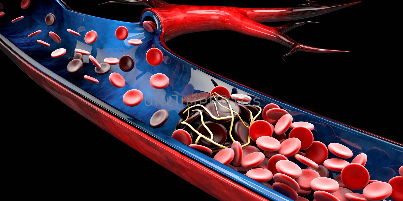 Sickle cell anemia, showing blood vessel with normal and deformated crescent. 3D illustration