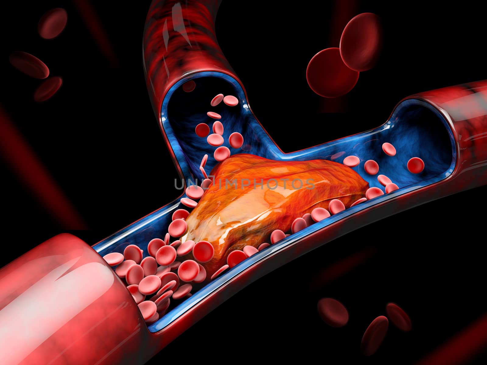 3d Illustration of Deep Vein Thrombosis or Blood Clots. Embolism.