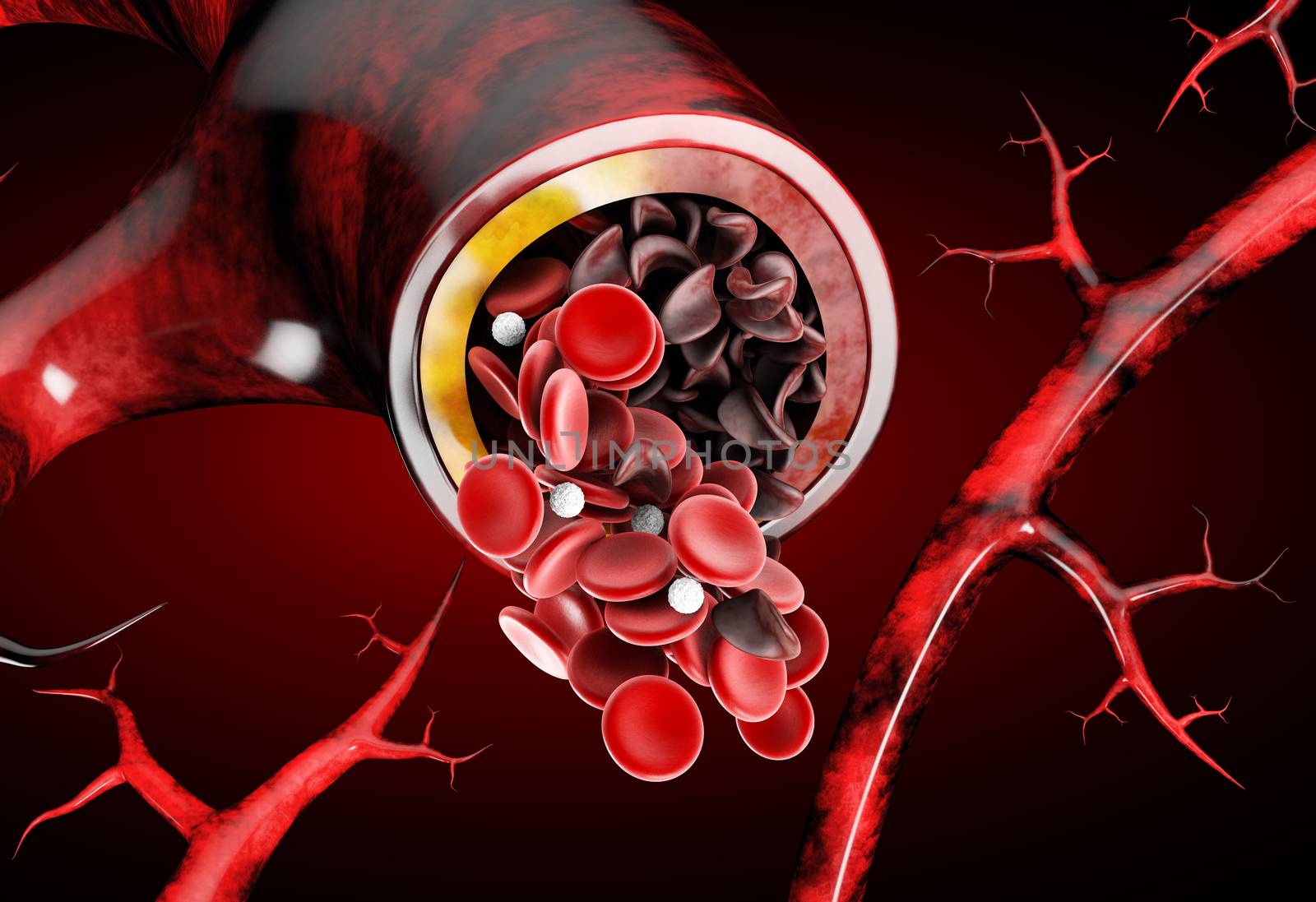 Sickle cell anemia, showing blood vessel with normal and deformated crescent 3D illustration.