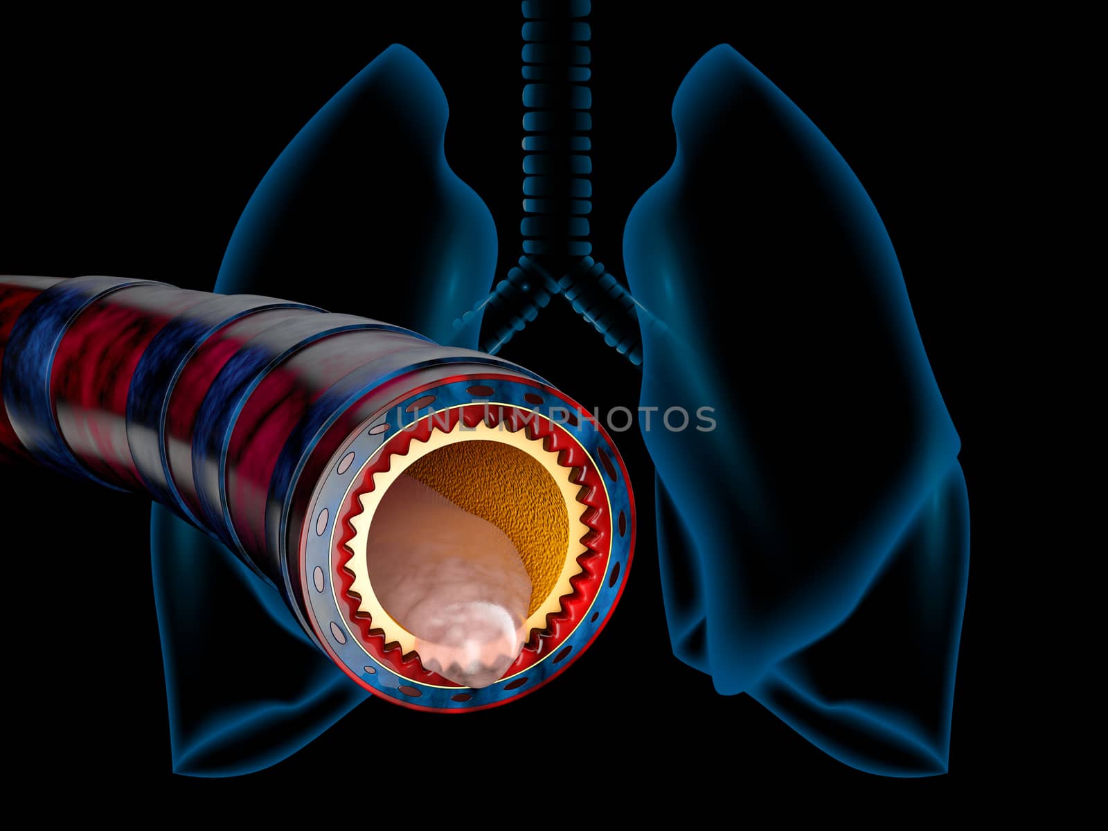 Bronchitis anatomy, mucus secreted as a chest cold as a 3D illustration.