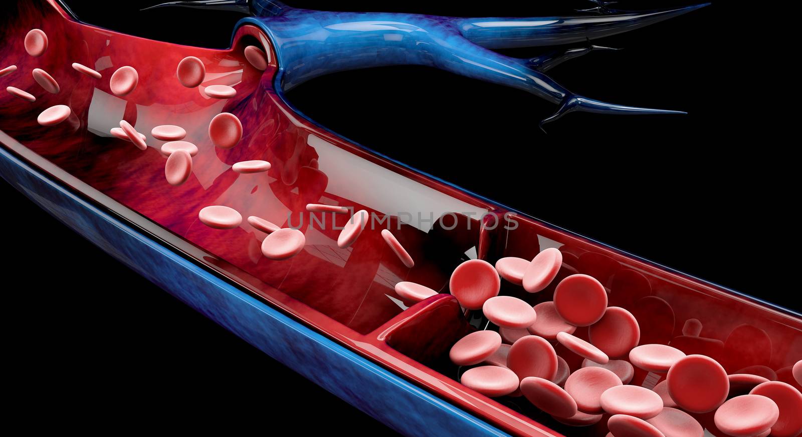 Varicose veins close up. Human legs on a black background, 3d Illustration.