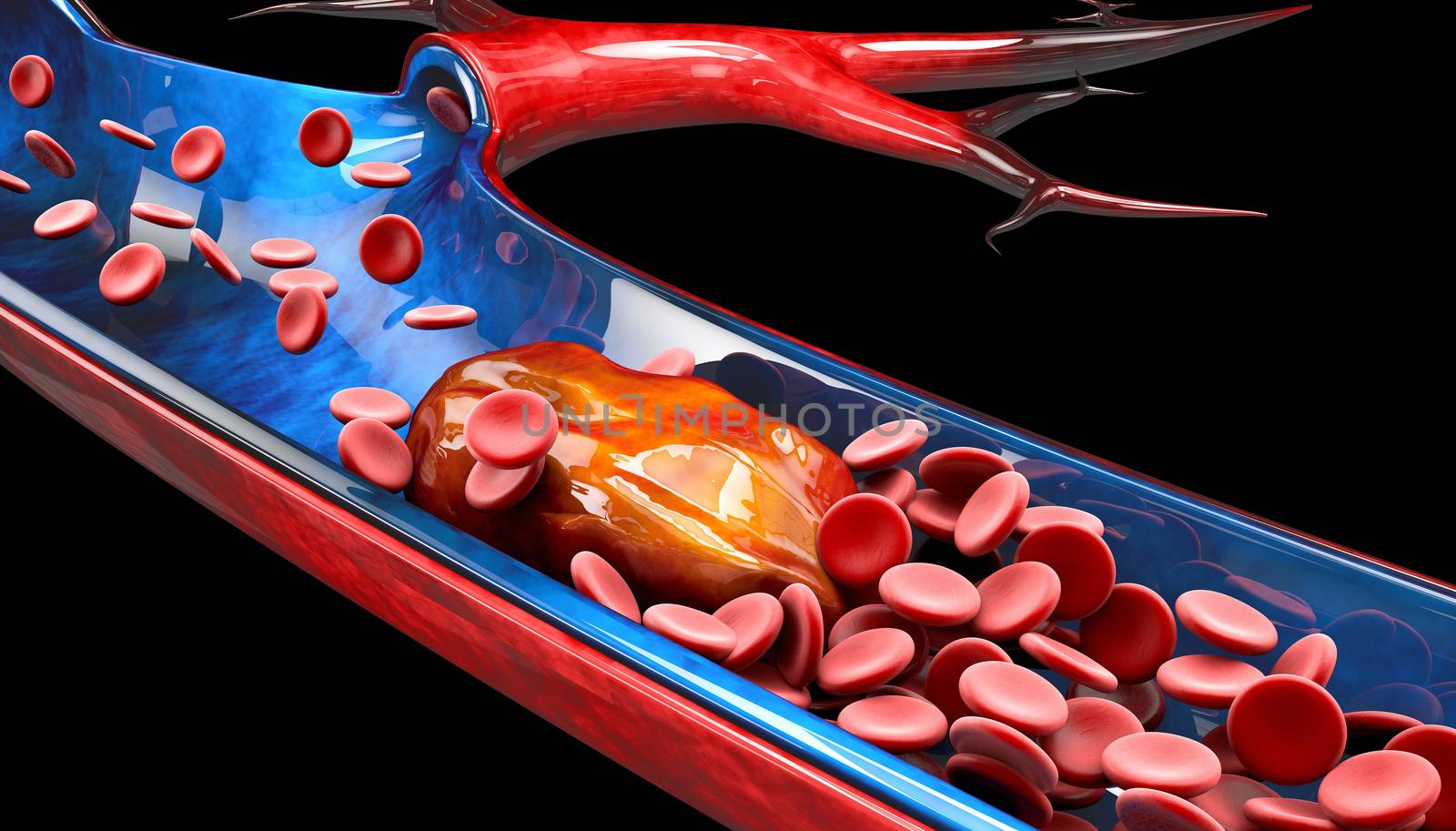 3d Illustration of Deep Vein Thrombosis or Blood Clots. Embolism