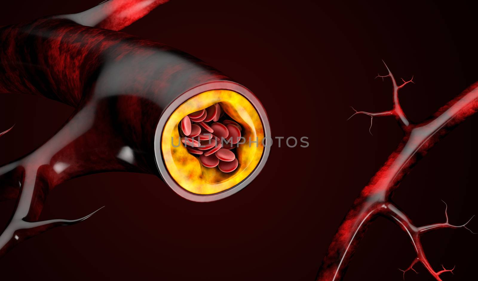 3d Illustration of blood cells with plaque buildup of cholesterol by tussik