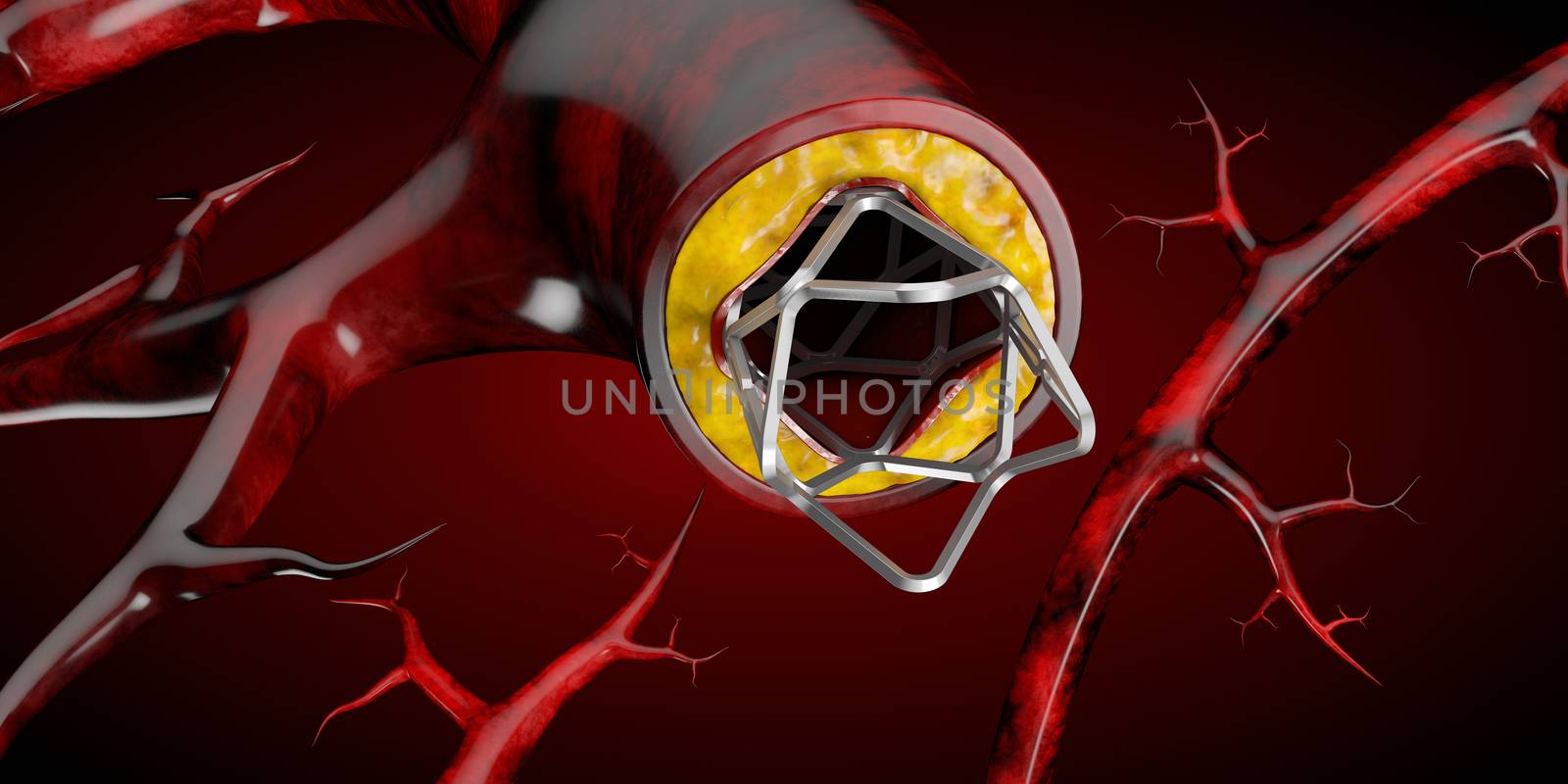 Stent medical implant concept as a heart disease treatment symbol 3D illustration by tussik