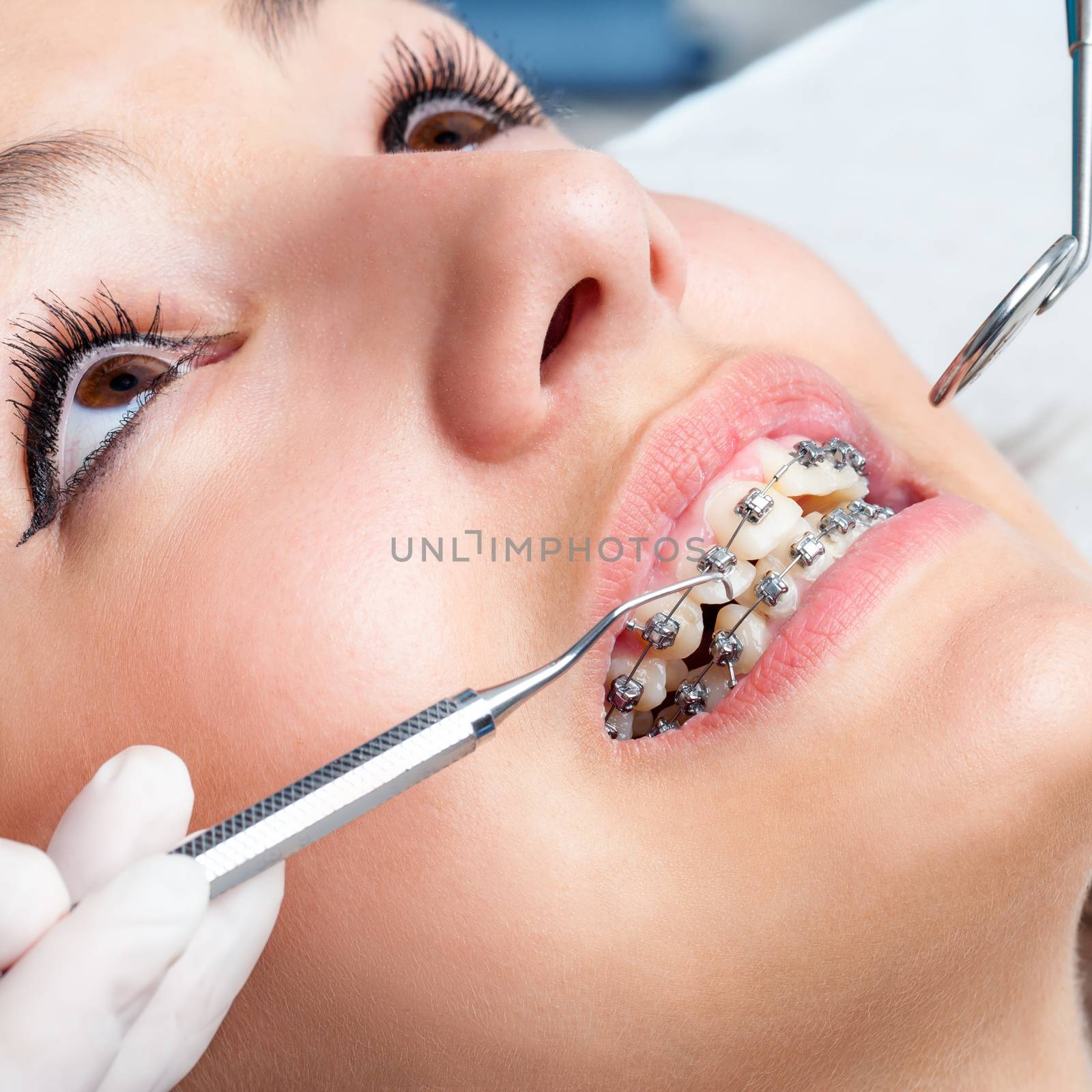 Extreme close up of hands working on dental braces with hatchet and mouth mirror. Macro close up of female mouth showing dental braces.