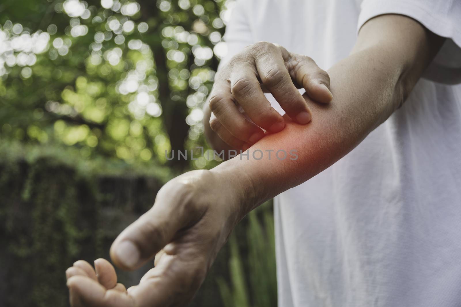 Man scratch itch with hand. Man scratching his hand healthcare concept.