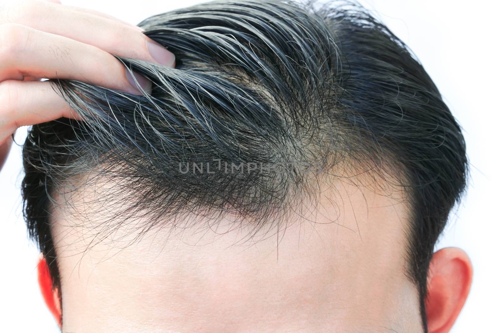 Young man serious hair loss problem for health care medical and shampoo product concept