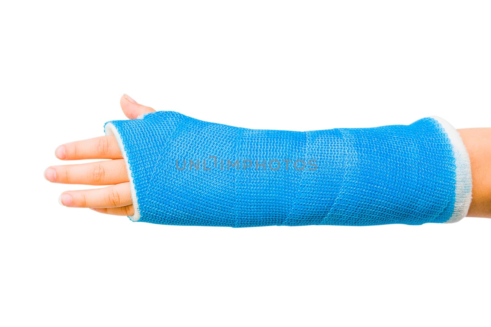 Cast of Child’s Broken Arm Isolated on White Background