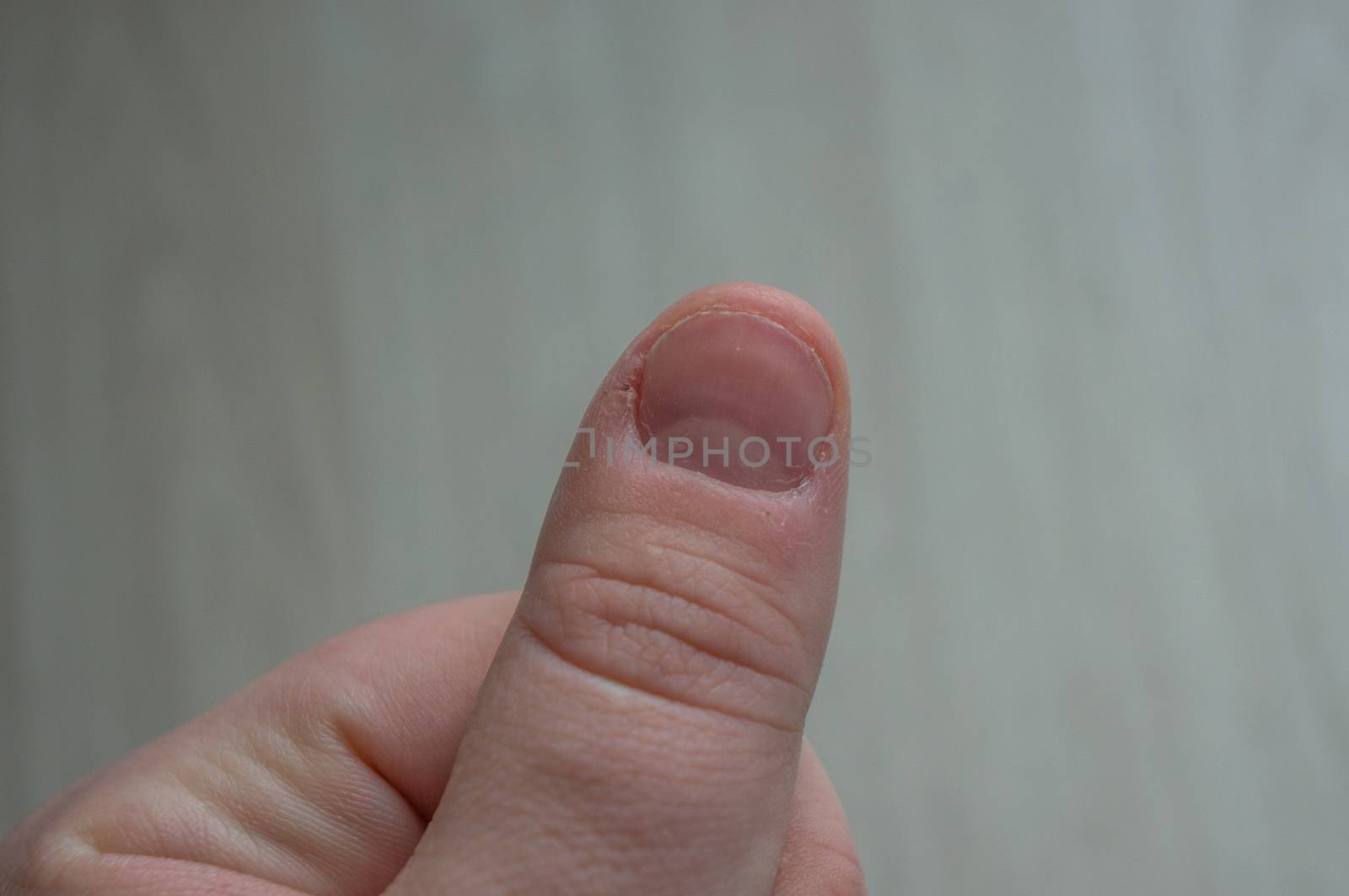 Damaged bitten thumbnail with torn cuticles and blisters. Condition due to obsessive, compulsory skin picking and nail biting. Conceptual of stress, anxiety, depression and other medical conditions.
