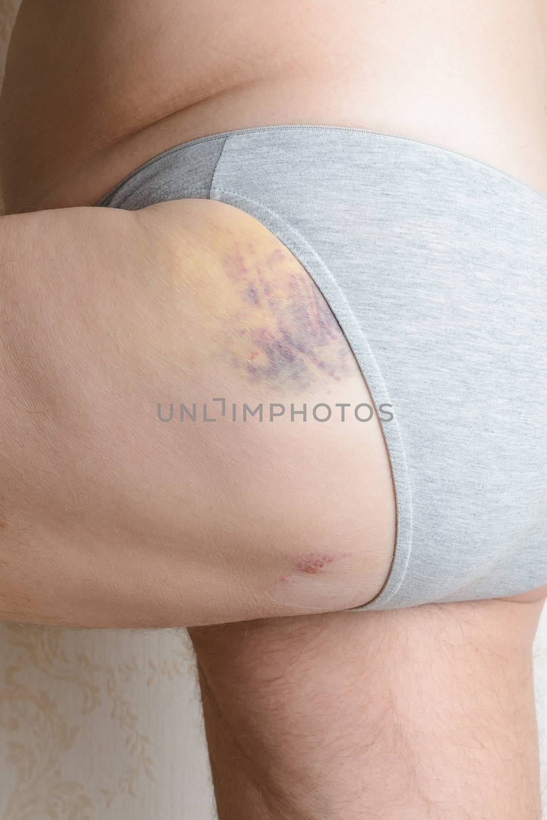 Traces of dog bite and hematoma to the buttock by MaxalTamor