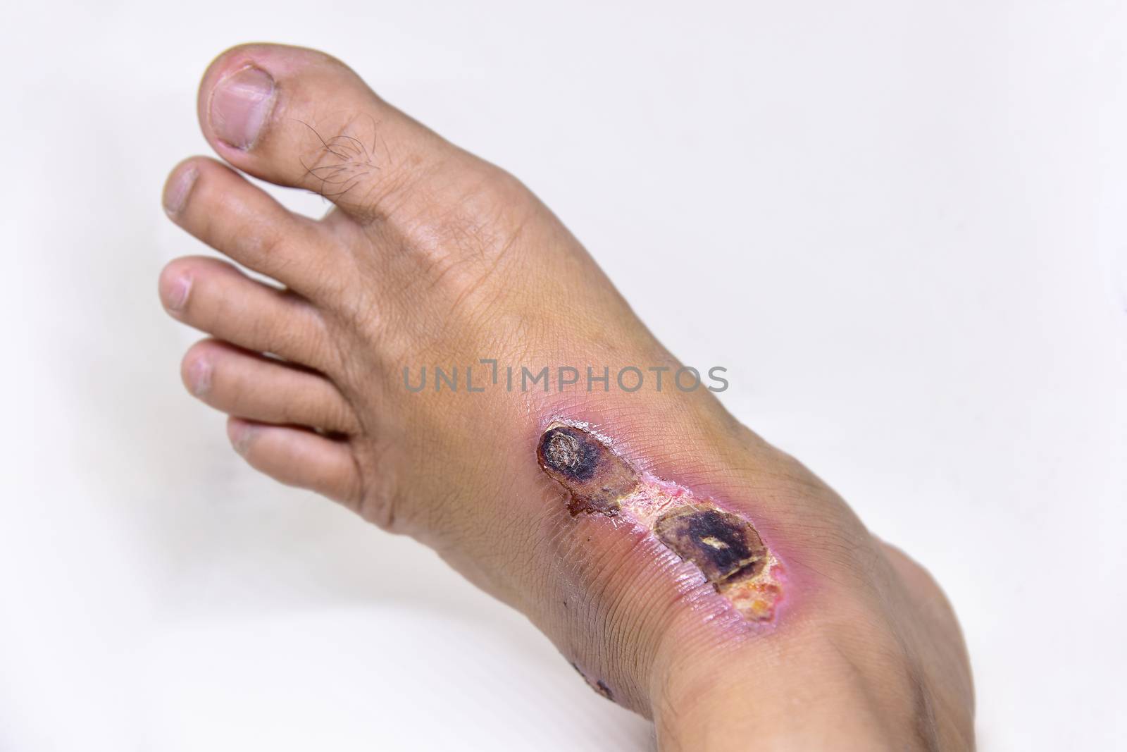 Closeup of blisters scab on man foot. by NuwatPhoto